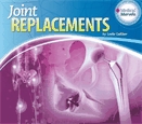 Joint replacements